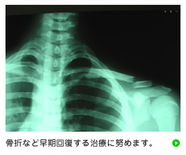 骨折など早期回復する治療に努めます。